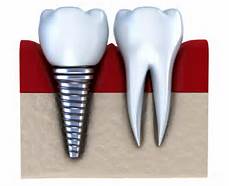 dental implants az