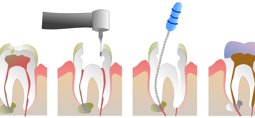 px Root Canal Illustration Molar