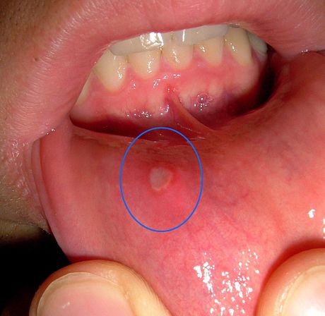 Remedies for Mouth Sores