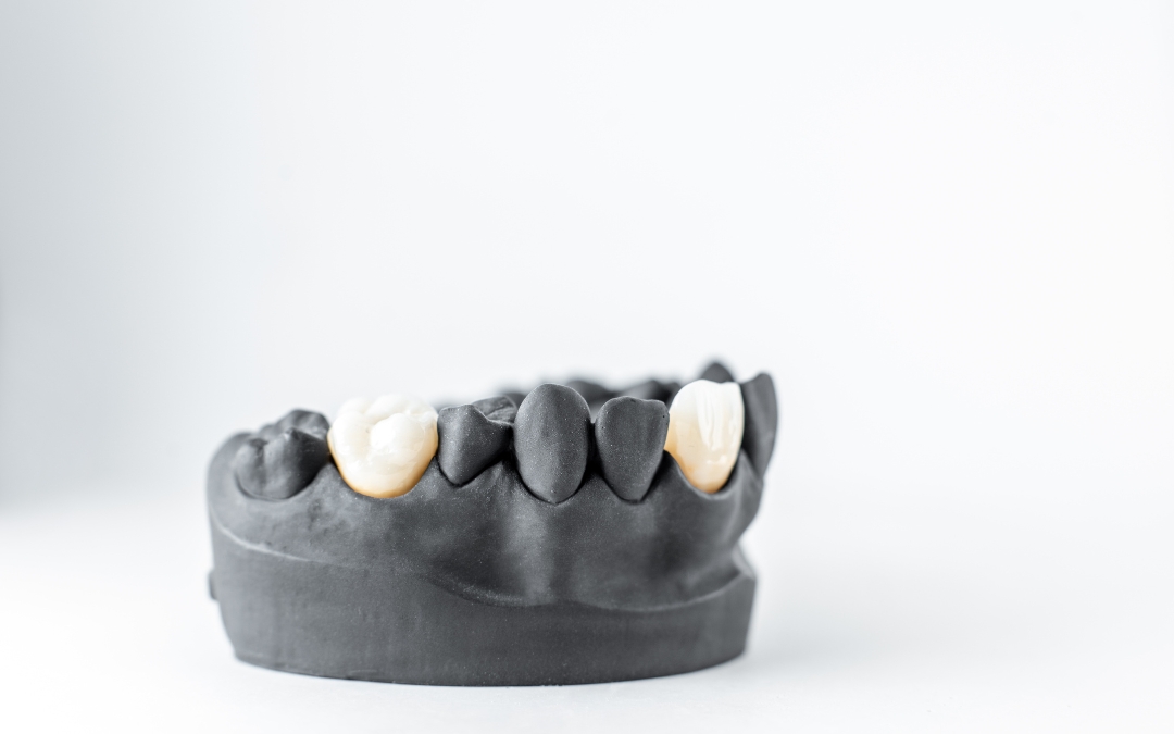 Do I Need a Dental Crown? 7 Signs You Shouldn’t Ignore