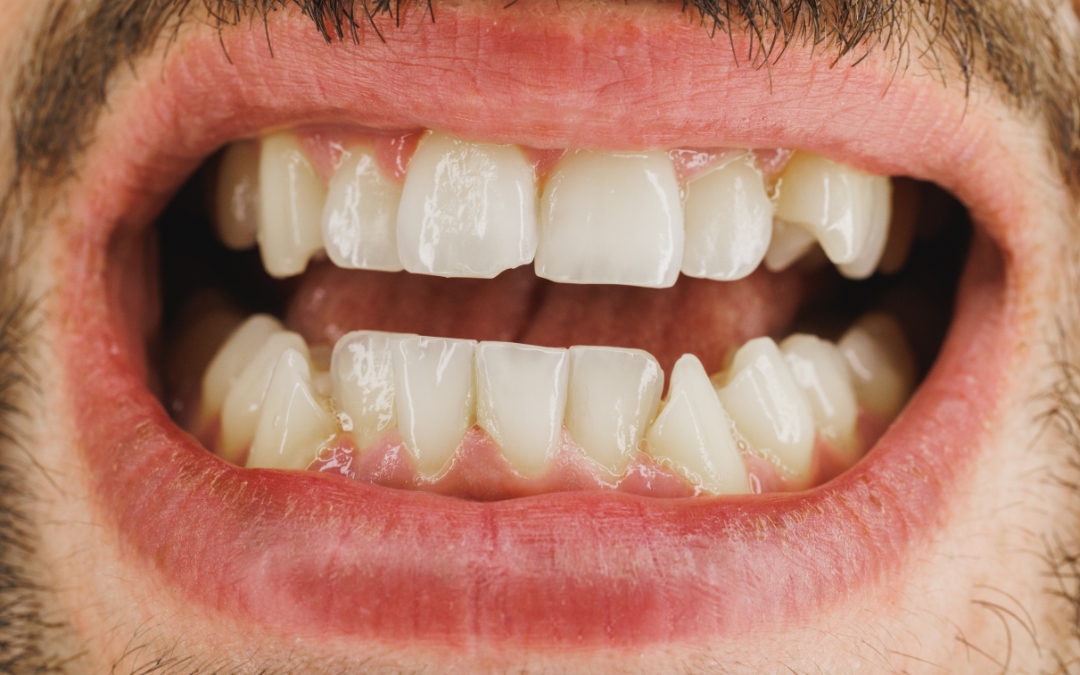 How a Cosmetic Dentist Can Fix Chipped or Crooked Teeth
