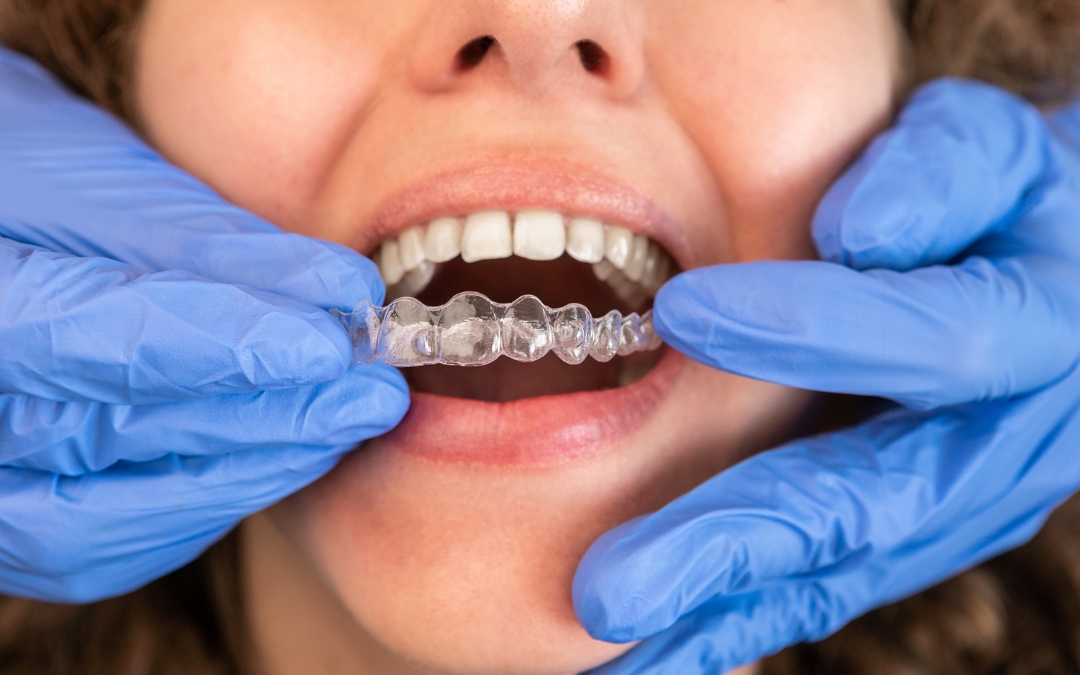 Who Is a Good Candidate for Invisalign?