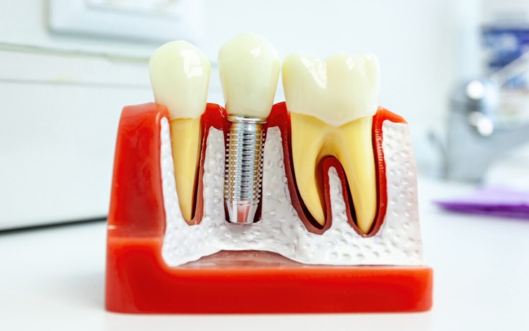 Can Dental Implants Help with Jaw Alignment or TMJ Issues?