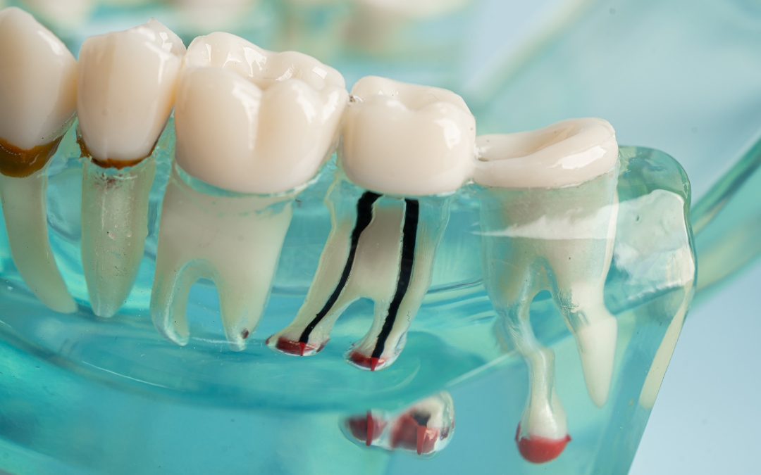 Does The Tooth Pain Increase Days After Root Canal Therapy?