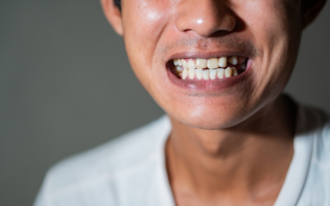 The Gap Between Your Dental Crown And Gums How To Fix It