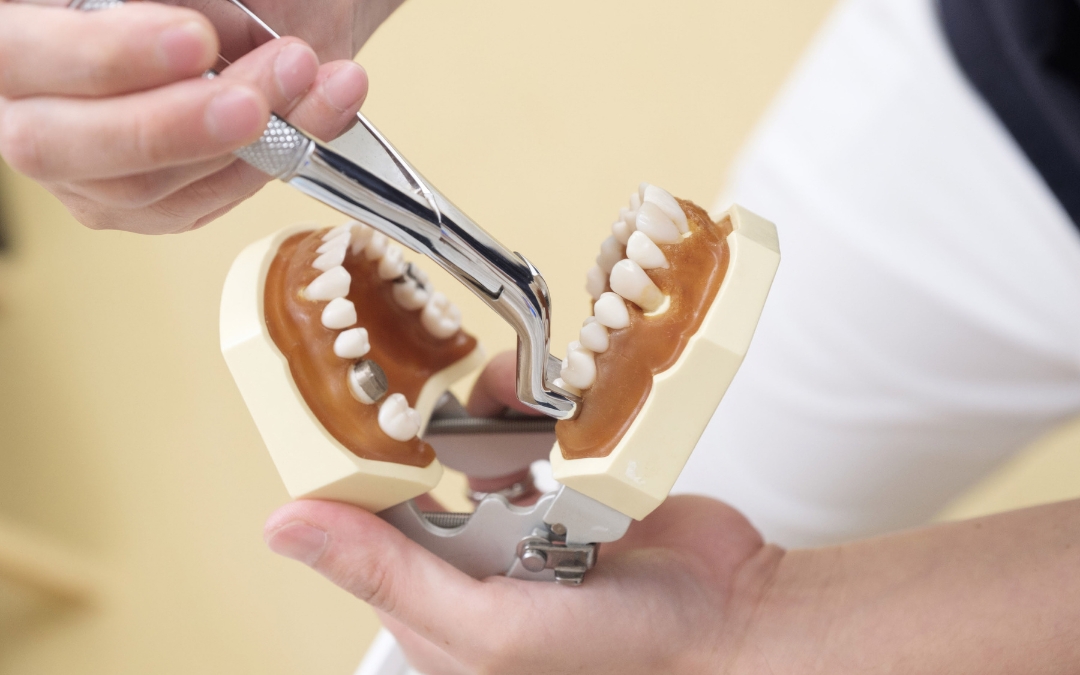 Does Wisdom Teeth Extraction Change Face Shape