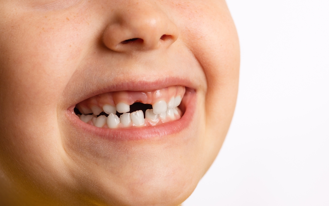 Does Your Child’s Permanent Tooth Still Grow If It’s Broken?