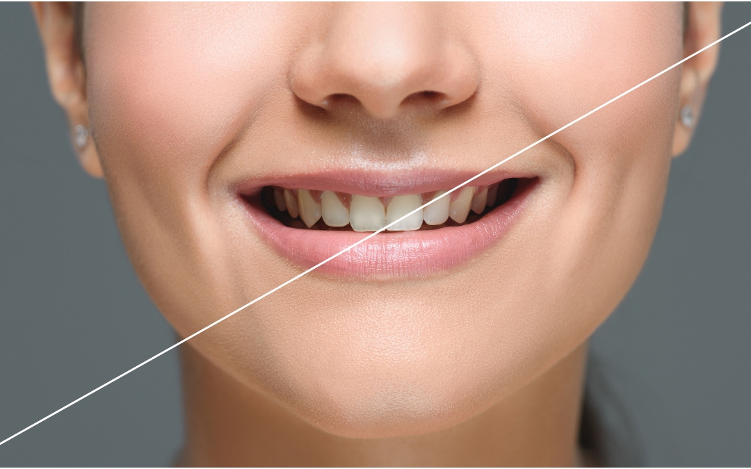 Homemade Teeth Whitening Solutions That Actually Work for Mesa Patients