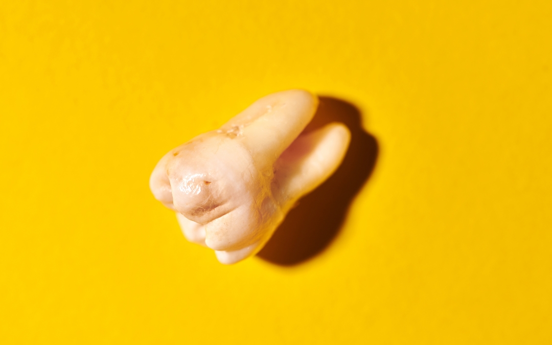 Should Decayed Wisdom Teeth Be Pulled Out